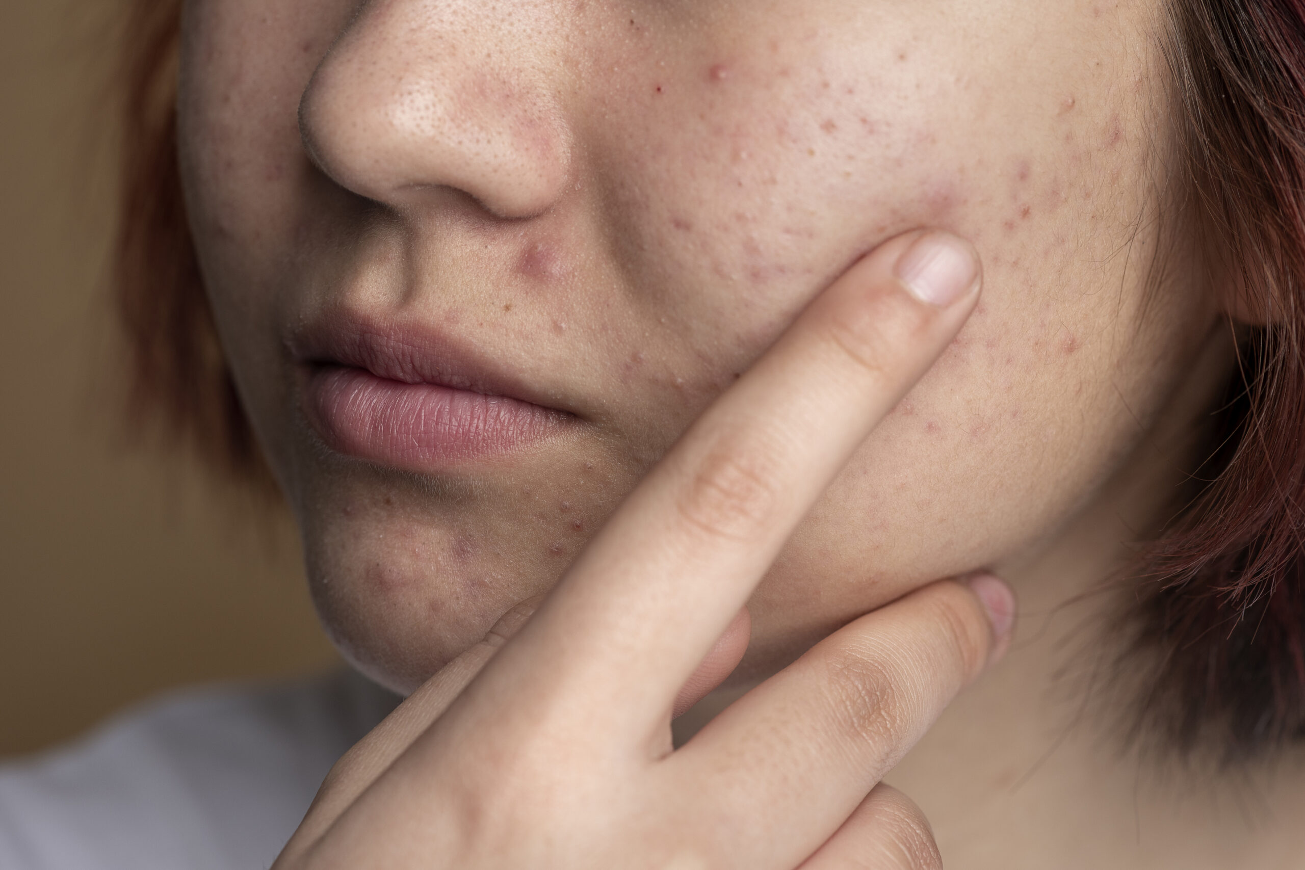 acné hormonal à 30 ans